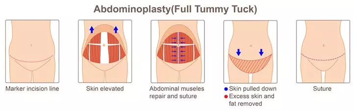 Process of full tummy tuck after C-section