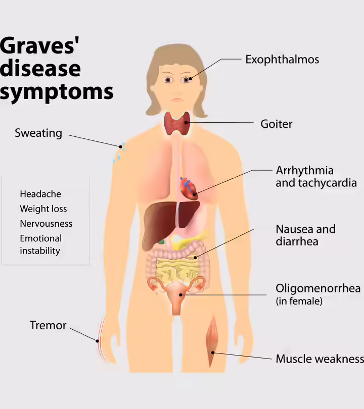 Graves Disease And Pregnancy: Causes, Symptoms, And Treatment