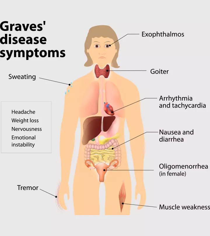 Graves Disease And  Pregnancy: Causes, Symptoms, And Treatment