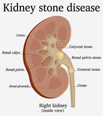 Kidney Stones During Pregnancy Causes, Symptoms, And Treatment