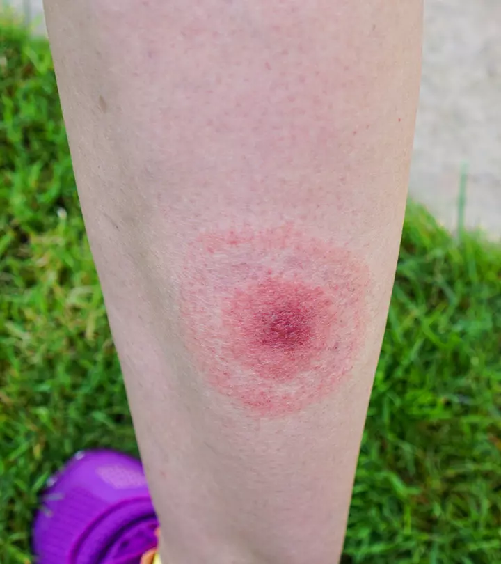 Lyme Disease During Pregnancy: Symptoms, Treatment And Prevention