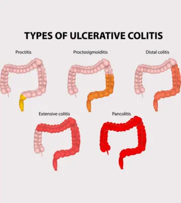 Some of the causes of ulcerative colitis in children may be controllable. 