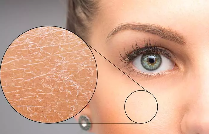 Dehydrated Skin