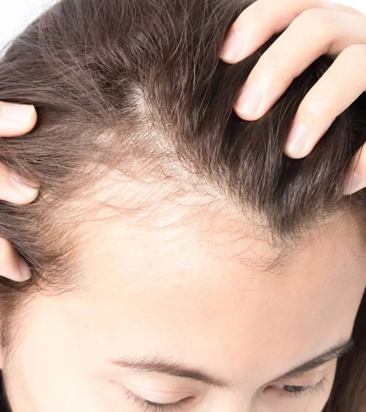 गंजेपन के कारण, लक्षण और घरेलू इलाज – 12 Home Remedies for Baldness in Hindi_image