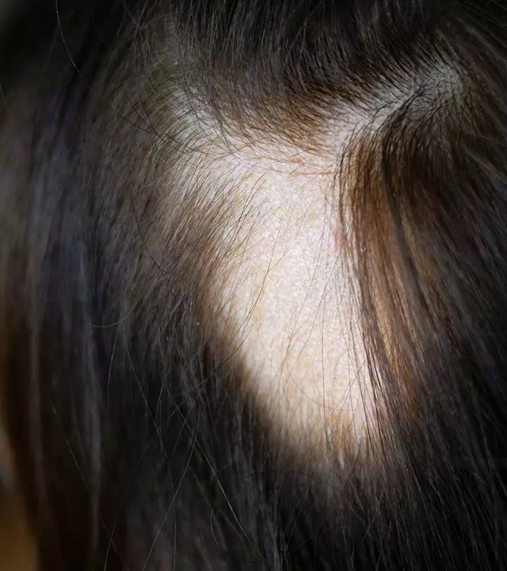 एलोपेशीया के कारण, लक्षण और घरेलू उपाय – Alopecia Causes, Symptoms and Home Remedies in Hindi_image