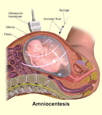 एम्नियोसेंटेसिस टेस्‍ट: प्रक्रिया, परिणाम व लागत  | Amniocentesis Test In Hindi_image