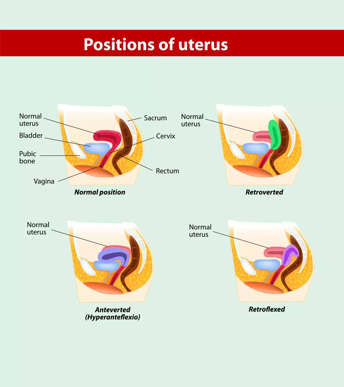 प्रेगनेंसी में एंटेवर्टेड यूटेरस: कारण, लक्षण व इलाज  | Anteverted Uterus Meaning In Hindi_image