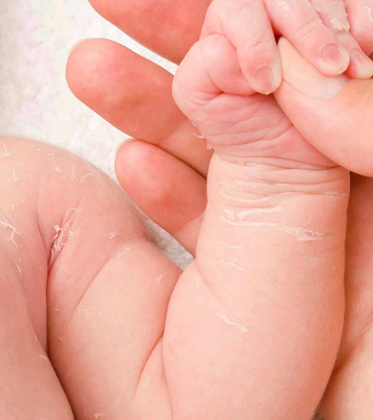 शिशुओं की रूखी त्वचा के कारण, लक्षण व घरेलू उपाय | Baby ki Dry Skin Care In Hindi_image