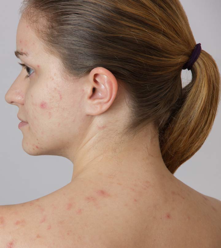 पीठ के मुंहासे के कारण, लक्षण और घरेलू उपाय – Back Acne Causes, Symptoms and Home Remedies in Hindi_image