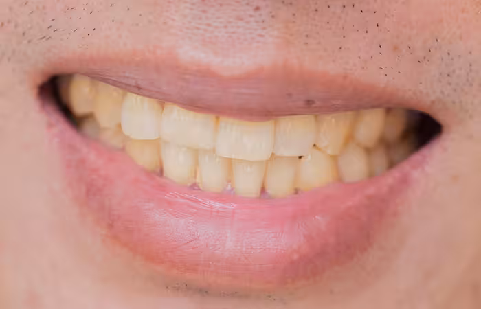 Causes of Yellow Teeth in Hindi