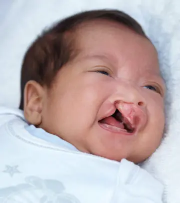 बच्चों में फांक (कटा) होंठ व तालु की समस्या | Cleft Lip And Palate Meaning In Hindi_image