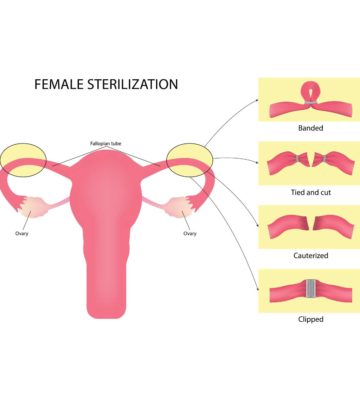 महिला नसबंदी: प्रक्रिया, लागत व ऑपरेशन के बाद देखभाल | Female Sterilization In Hindi_image