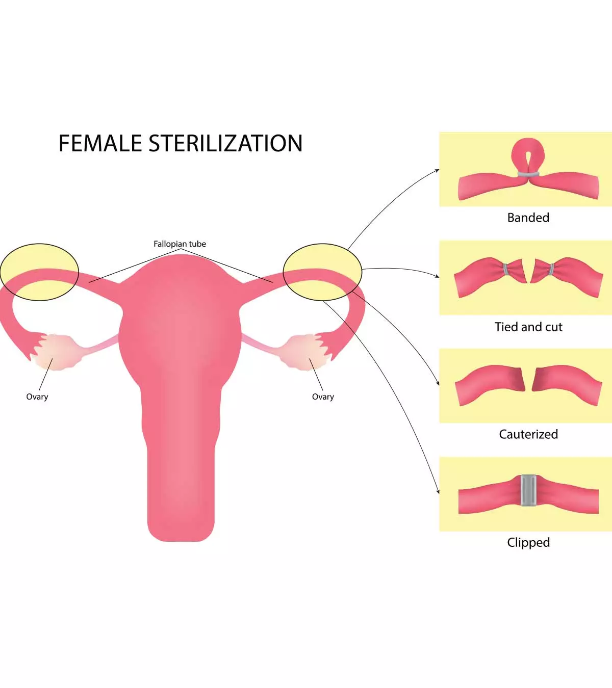 महिला नसबंदी: प्रक्रिया, लागत व ऑपरेशन के बाद देखभाल | Female Sterilization In Hindi_image