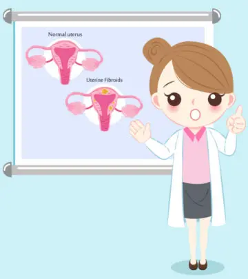 गर्भाशय फाइब्रॉएड (रसौली) के कारण, लक्षण, इलाज और घरेलू उपचार – Fibroids Symptoms, Treatment and Remedies in Hindi_image