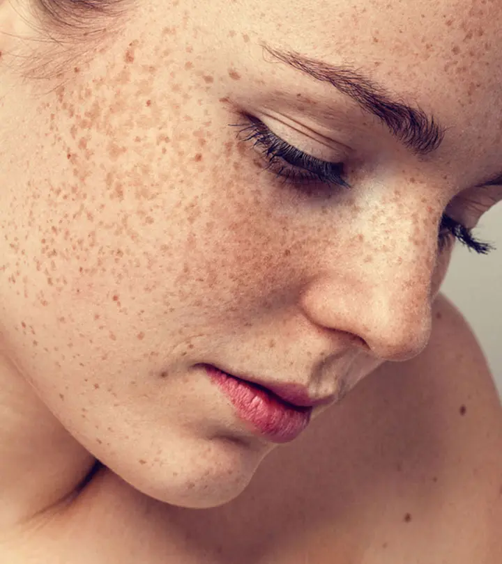 झाई (फ्रेकल्स) के कारण और घरेलू उपाय – Freckles Causes and Home Remedies in Hindi_image