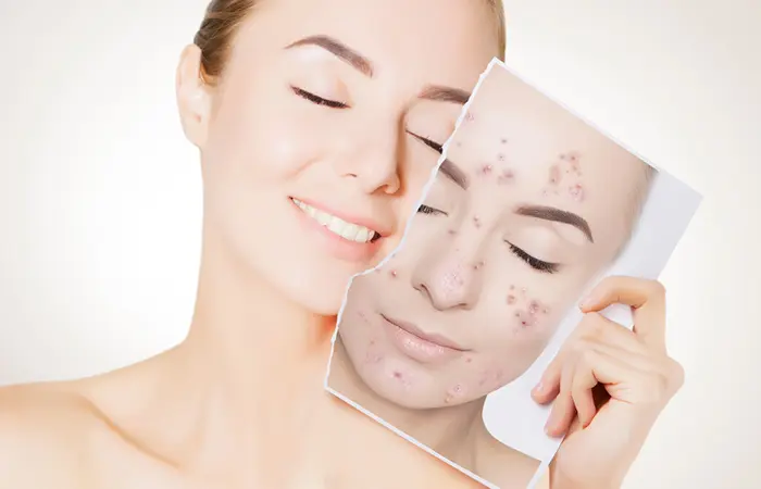 Besan will Get rid of acne in hindi