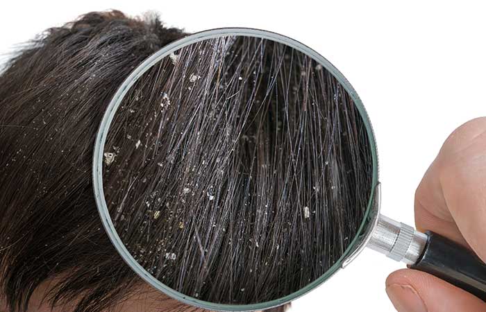 Get rid of dandruff