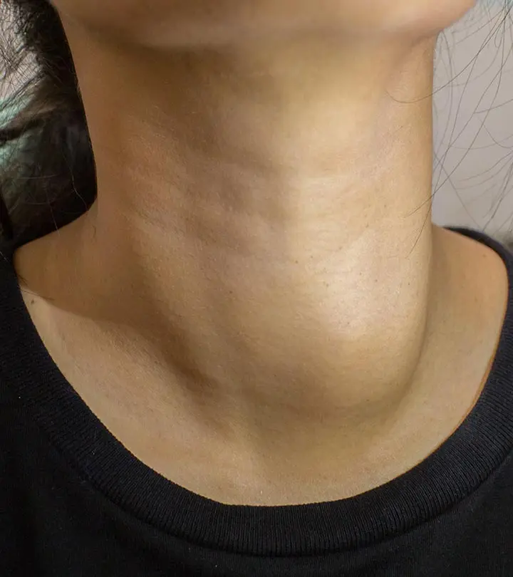 घेंघा के कारण, लक्षण और इलाज – Goiter Causes, Symptoms and Treatment in Hindi_image