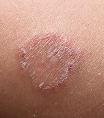 दाद के कारण, लक्षण, इलाज और घरेलू उपाय – Home Remedies For Ringworm in Hindi_image