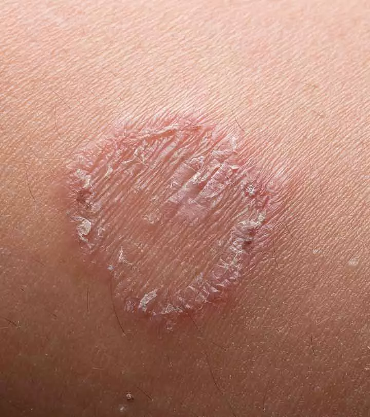 दाद के कारण, लक्षण, इलाज और घरेलू उपाय – Home Remedies For Ringworm in Hindi_image