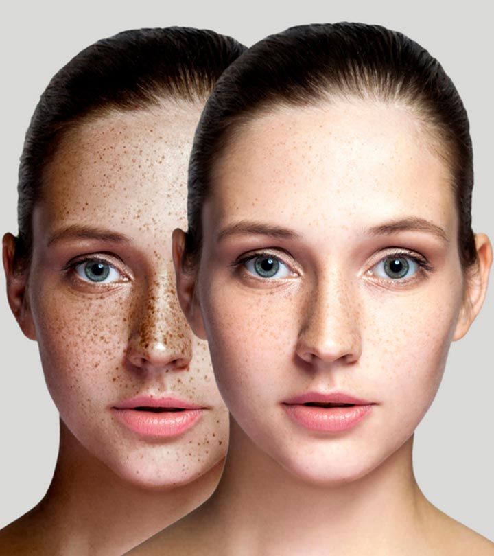 झाइयां दूर करने के लिए घरेलू उपाय – Home Remedies For Skin Pigmentation In Hindi