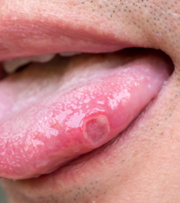 जीभ के छाले होने के कारण, लक्षण और घरेलू इलाज – Home Remedies for Tongue Ulcer in Hindi_image