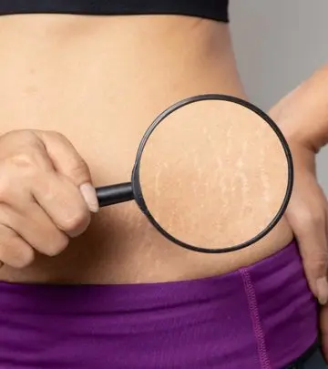 स्ट्रेच मार्क्स हटाने के उपाय – How To Remove Stretch Marks in Hindi_image