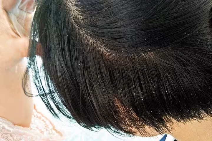 How to know if a child has lice in his hair