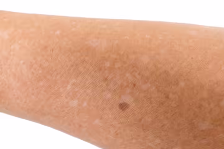 Idiopathic guttate hypomelanosis