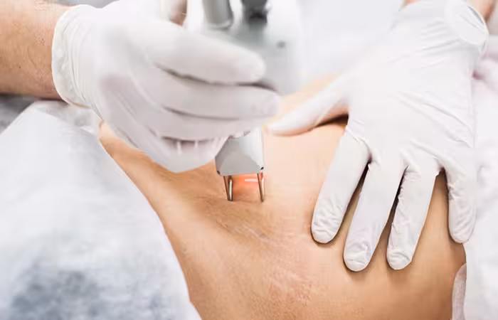 Woman getting laser therapy for stretch marks