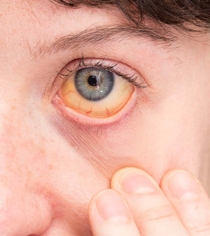 पीलिया के कारण, लक्षण और घरेलू इलाज Jaundice (Piliya) Home Remedies