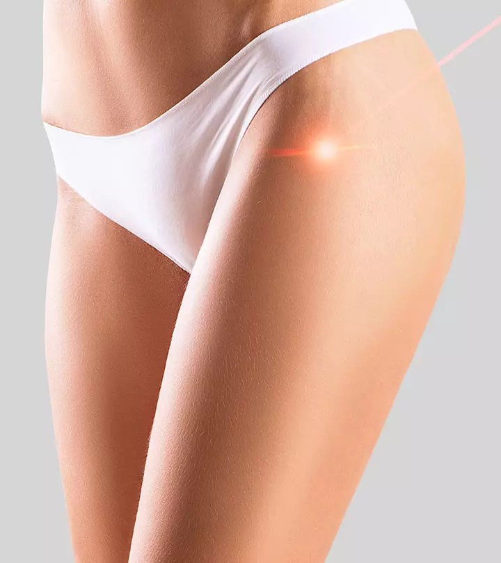 Laser Stretch Mark Removal: Types, Cost, And How It Works_image