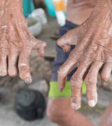 कुष्ठ रोग के कारण, लक्षण और इलाज – Leprosy Causes, Symptoms and Treatment in Hindi_image