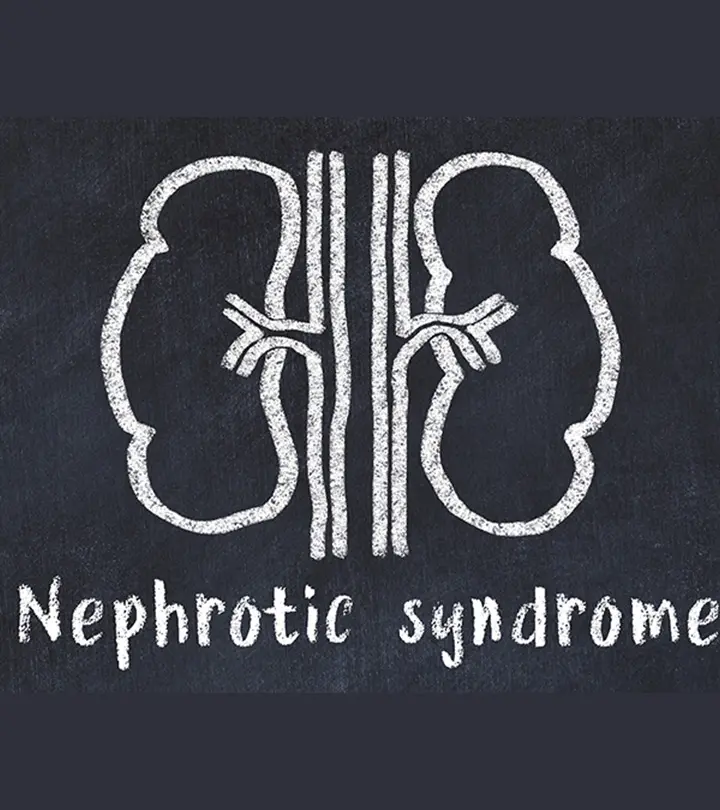 नेफ्रोटिक सिंड्रोम के कारण, लक्षण और इलाज – Nephrotic Syndrome in Hindi_image