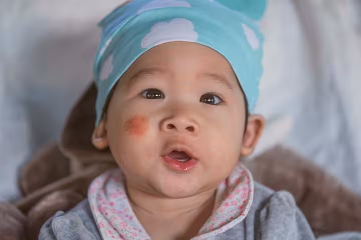 Pityriasis alba