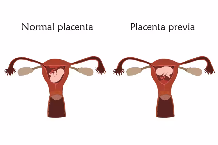 Placenta Previa