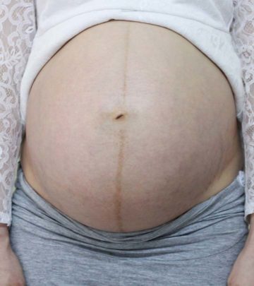 गर्भावस्था के दौरान पेट पर काली रेखा (लिनिया नाइग्रा) | Pregnancy Me Pet Par Kali Line_image