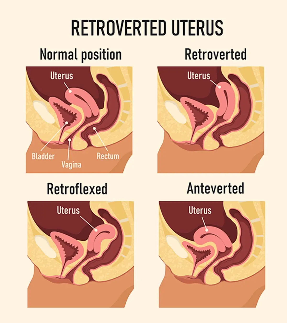 प्रेगनेंसी में रेट्रोवर्टेड यूट्रस: कारण, लक्षण व इलाज | Retroverted Uterus Meaning In Hindi_image