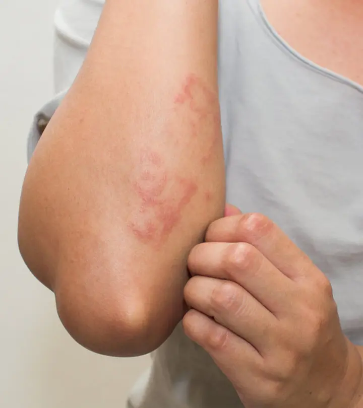 त्वचा पर चकत्ते के कारण, लक्षण और घरेलू उपाय – Skin Rashes Causes, Symptoms and Home Remedies in Hindi_image