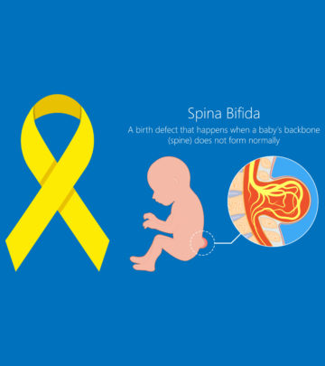 स्पाइना बिफिडा क्या है? कारण, लक्षण व इलाज | Spina Bifida In Hindi_image