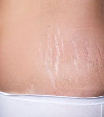 गर्भावस्था के स्ट्रेच मार्क्स हटाने के उपाय | Stretch Marks Hatane Ke Upay_image