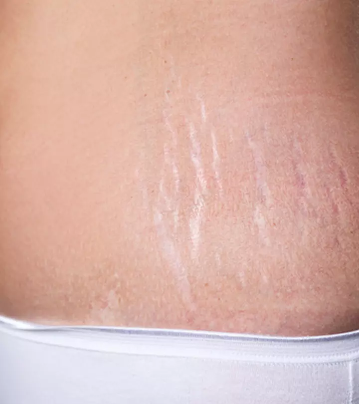 गर्भावस्था के स्ट्रेच मार्क्स हटाने के उपाय | Stretch Marks Hatane Ke Upay_image