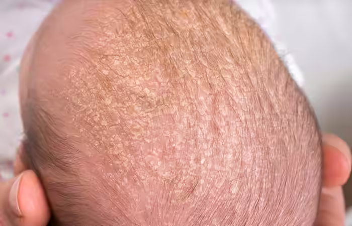To prevent scalp infection