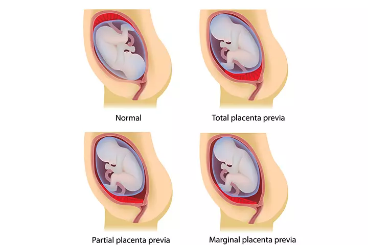 Types of Pleasantia Previa