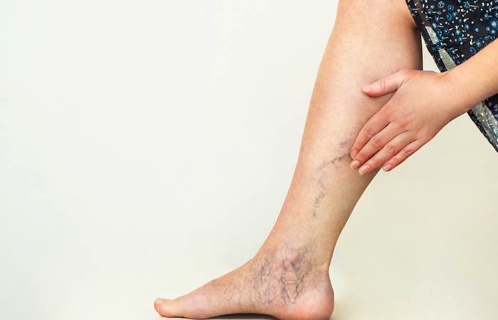 Types of Varicose Veins in Hindi (3)