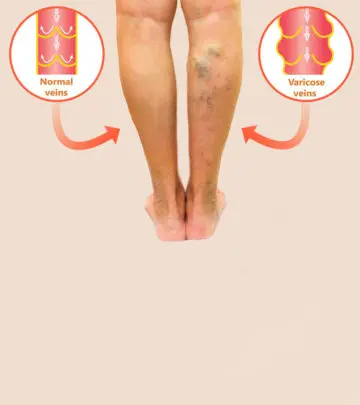 वैरिकोज वेन्स के कारण, लक्षण और इलाज – Varicose Veins Causes, Symptoms and Treatment in Hindi_image