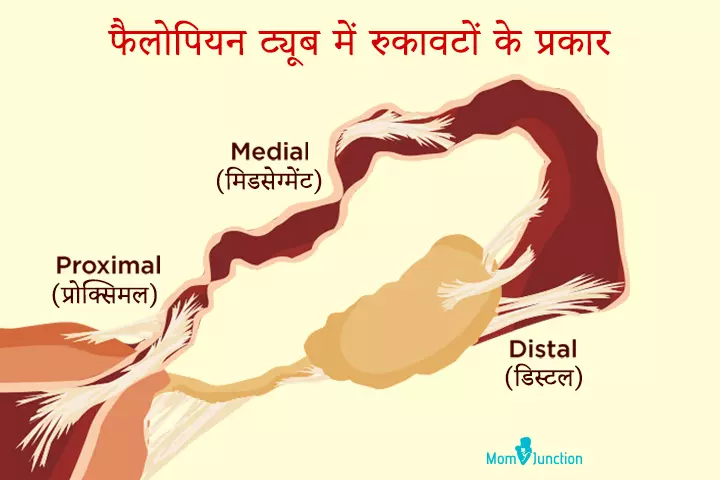 Types of blockages in fallopian tubes