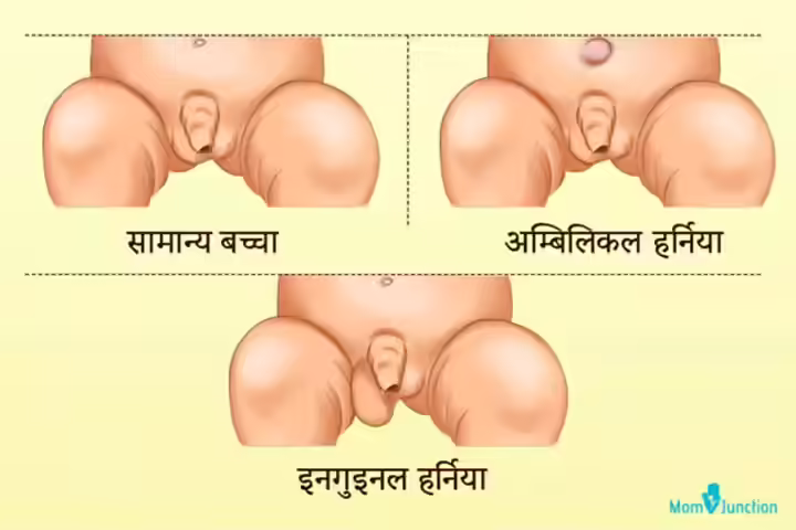 Types of hernia in children