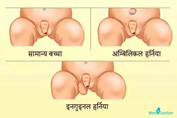 Types of hernia in children