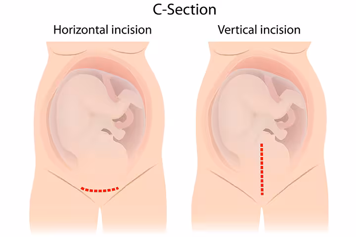 Uterine incision